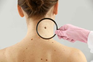 İzmir Dermatolog Dr. Orhan Demirer 17 Ben değerlendirmesi İzmir dermatolog muayenesi ve dermatoskopik inceleme