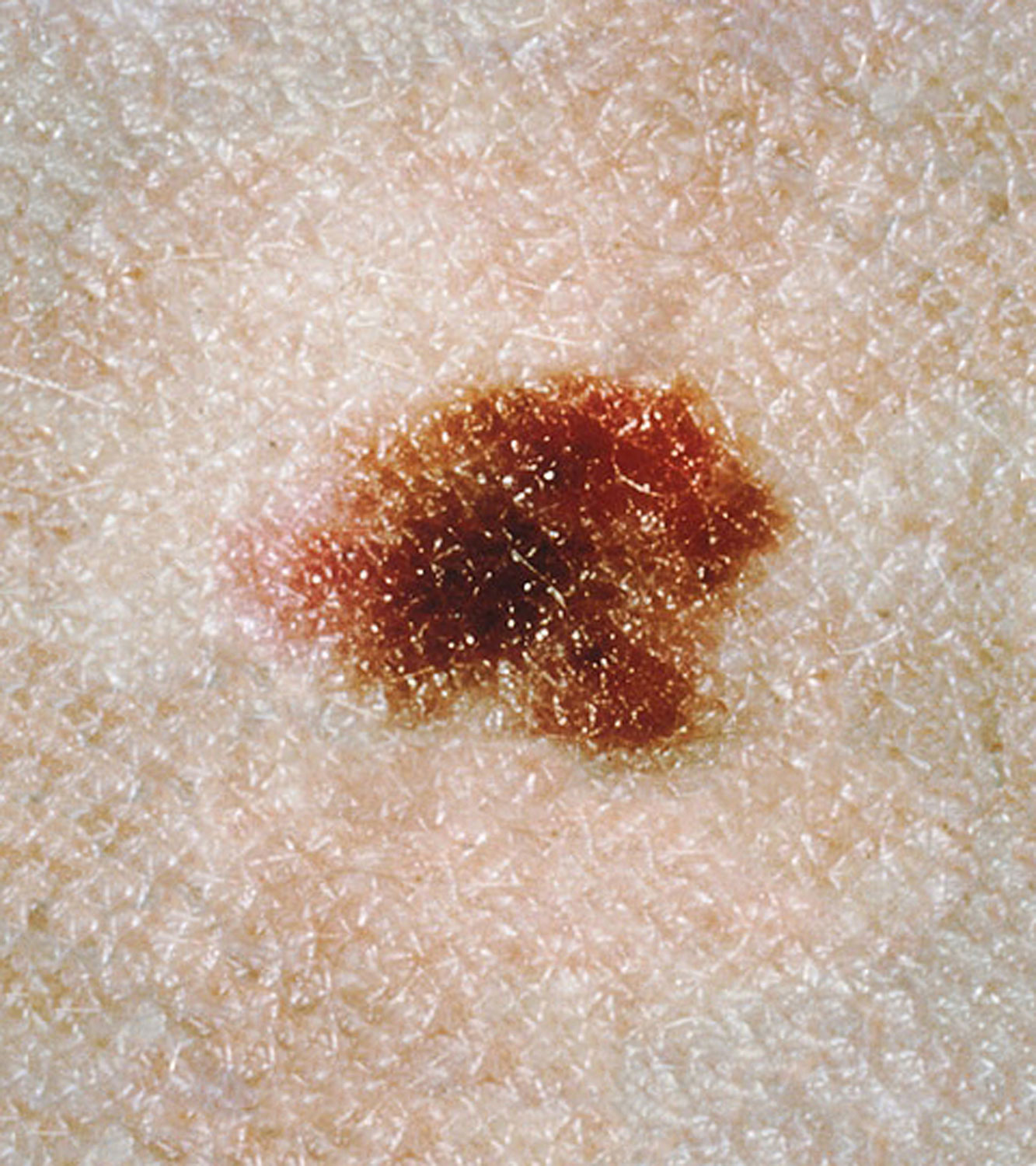 Displastik ben (atipik nevüs) dermatolojik değerlendirmesi İzmir’de Dr. Orhan Demirer ile ben takibi ve deri kanseri açısından muayene