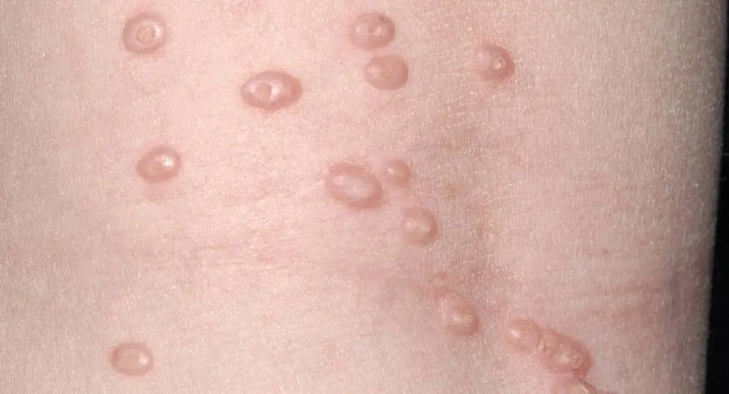 Molluskum kontagiozum tedavisi İzmir Alsancak muayenehanesinde Dr. Orhan Demirer ile ciltte görülen viral lekelerin tanı ve tedavisi