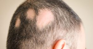 Saçkıran tedavisi İzmir için yama şeklinde saç dökülmesinin dermatolog değerlendirmesi