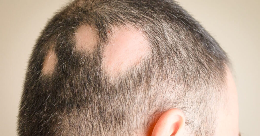 Saçkıran (alopesi areata) tedavisi İzmir Alsancak muayenehanesinde Dr. Orhan Demirer ile yama biçimli saç dökülmesinin tanı ve tedavisi