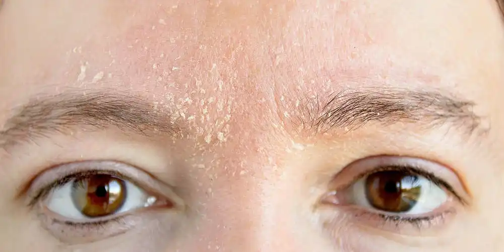 Seboreik dermatit tedavisi İzmir Alsancak muayenehanesinde Dr. Orhan Demirer ile saçlı deri ve yüz bölgesinde kızarıklık ve kaşıntının giderilmesi