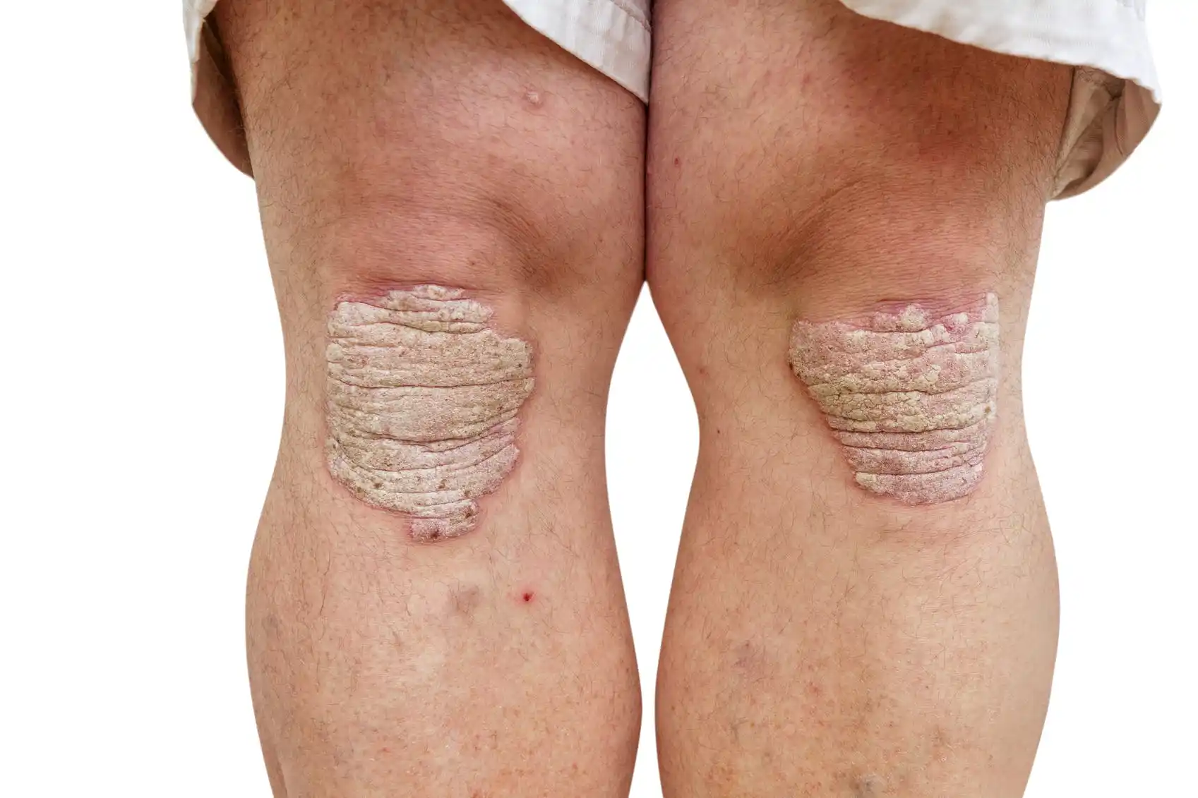 Sedef hastalığı (psoriasis) tedavisi İzmir Alsancak muayenehanesinde Dr. Orhan Demirer ile ciltte kızarıklık ve pullanmanın giderilmesi