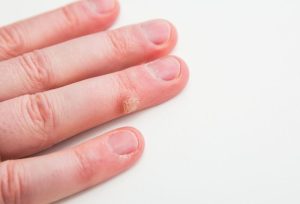 İzmir Dermatolog Dr. Orhan Demirer 16 Siğil tedavisi İzmir Alsancak dermatolog Dr. Orhan Demirer kliniğinde değerlendirme