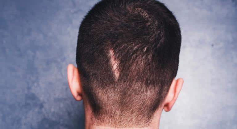 Skatrisyel alopesi (iz bırakan saç kaybı) tedavisi İzmir Alsancak muayenehanesinde Dr. Orhan Demirer ile kalıcı saç kaybının değerlendirilmesi ve tedavi seçenekleri
