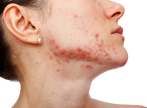 İzmir Dermatolog Dr. Orhan Demirer 14 Yüzün alt bölgesinde aktif akne ve sivilce izi görünümünü gösteren akne tedavisi görseli