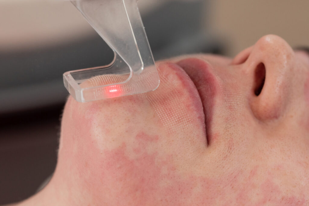 Fraksiyonel CO2 lazer ile cilt yenileme uygulaması İzmir