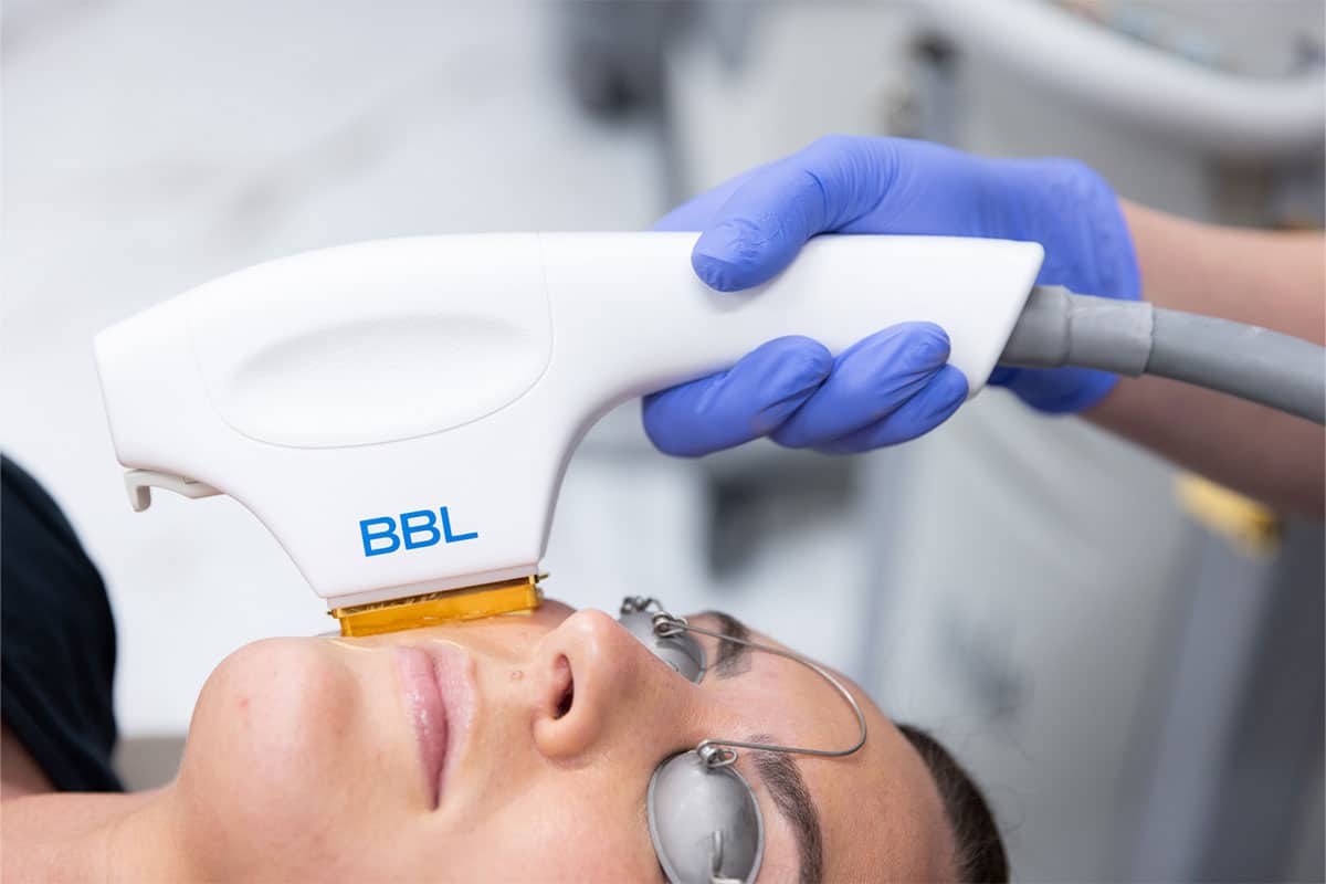 BBL-Laser-Behandlung in Izmir bei Hautarzt Dr. Orhan Demirer bei ausgewählten Pigmentflecken, Rötungen und ungleichmäßigem Hautbild