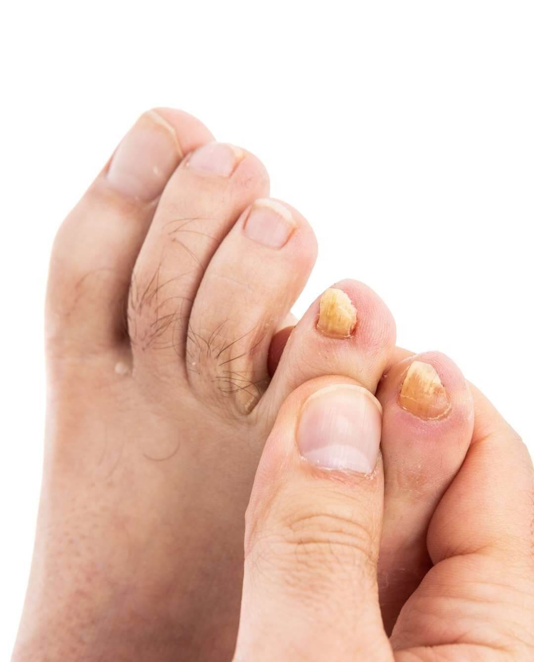 Fungal infection treatment in Izmir with dermatologist Dr. Orhan Demirer after examination of skin, nail or foot involvement and diagnosis