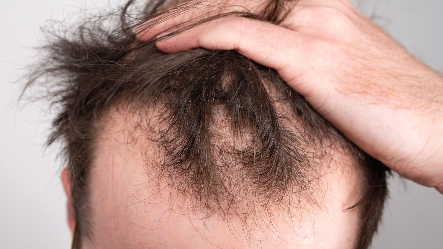 Haarausfall-Behandlung in Izmir bei Hautarzt Dr. Orhan Demirer nach dermatologischer Ursachenklärung und individueller Therapieplanung