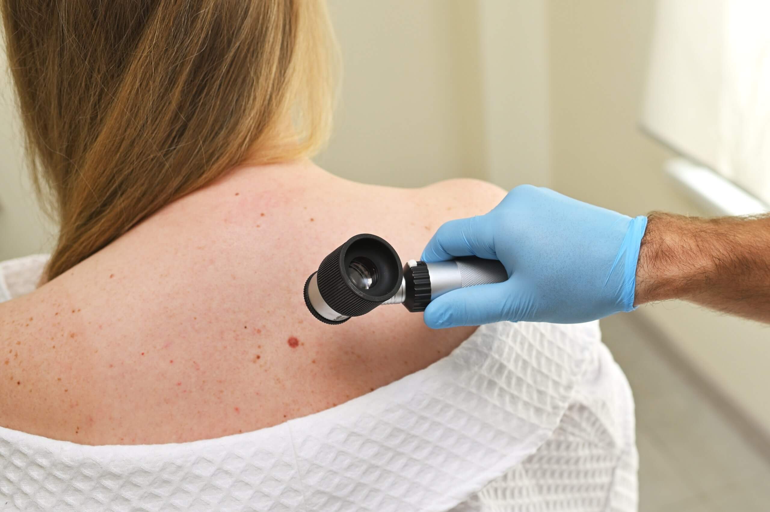 Laser mole removal in Izmir with dermatologist Dr. Orhan Demirer after dermatological assessment of lesion type, suitability and need for histopathology