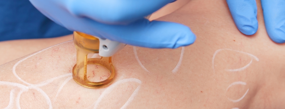Laser-Venenbehandlung in Izmir bei Hautarzt Dr. Orhan Demirer bei ausgewählten sichtbaren Gefäßen nach dermatologischer und vaskulärer Beurteilung