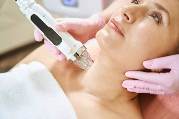 RF microneedling in Izmir with dermatologist Dr. Orhan Demirer for acne scars, skin texture and tightening
