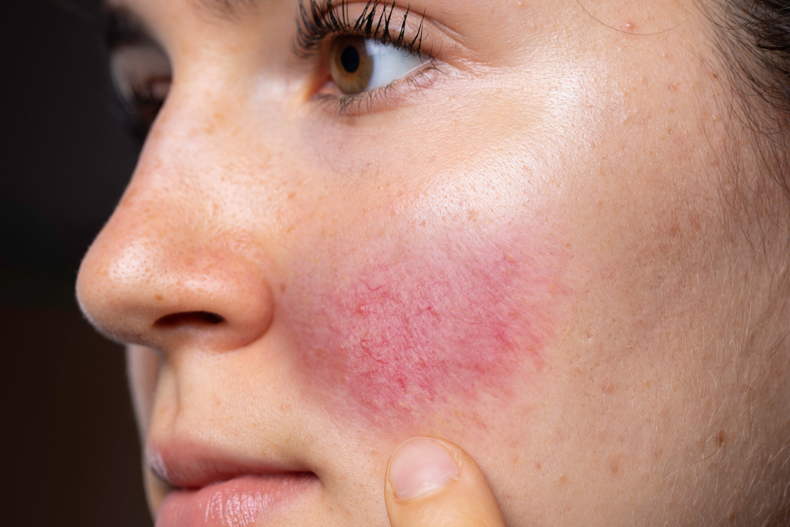 Rosacea treatment in Izmir with dermatologist Dr. Orhan Demirer after assessment of redness, flushing, visible vessels, inflammation and triggers