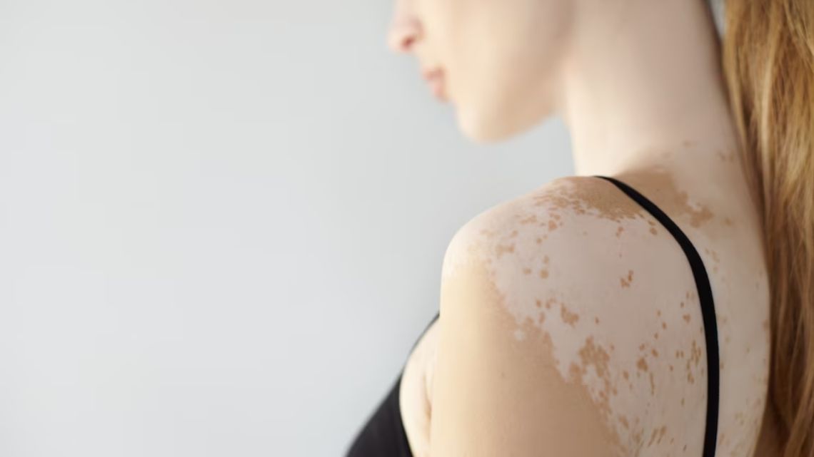 Vitiligo treatment in Izmir with dermatologist Dr. Orhan Demirer after assessment of pigment loss pattern, activity and suitable treatment options